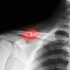 Signs And Symptoms Of A Clavicle Fracture | Detroit Chinatown