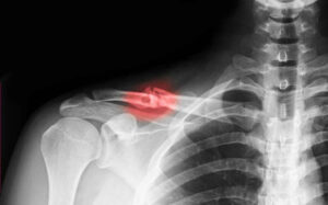 Signs And Symptoms Of A Clavicle Fracture | Detroit Chinatown